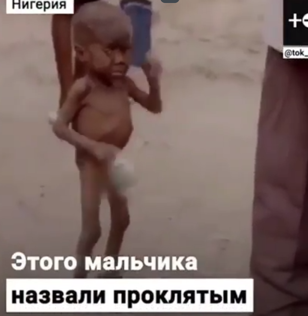 Больной малыш из нигерийской деревни оказался брошенным на произвол судьбы 