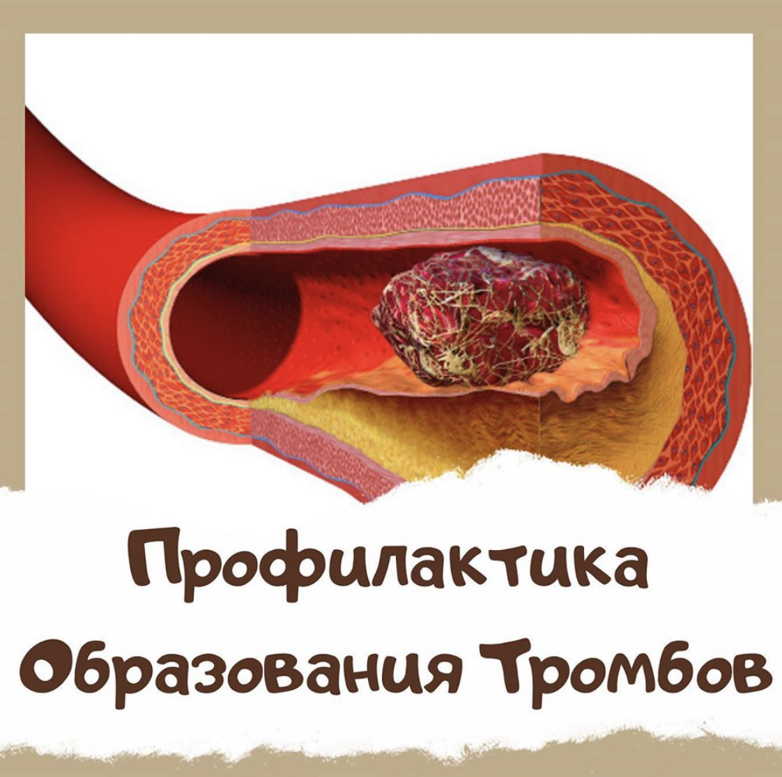 Профилактика образования тромбов