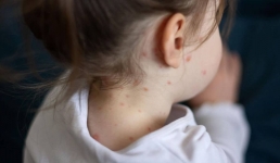 Врачи рассказали о состоянии находящихся в реанимации больных корью детей в Актау