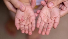 В Мангистау за сутки выявлено почти 30 случаев заболевания корью