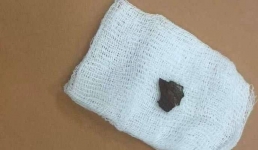 Проглотил кусочек плинтуса: в Мангистау врачи спасли 11-месячного ребенка