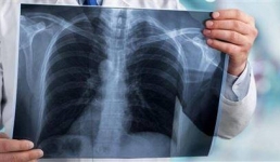 Заболеваемость туберкулезом в Мангистау осталась на уровне прошлого года