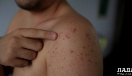 В Мангистау зарегистрировали более четырех тысяч случаев кори