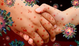 В Мангистау лабораторно подтверждено свыше 4 тысяч случаев заболевания корью