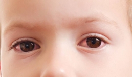 Врачи советуют не посещать детсады Экибастуза детям с конъюнктивитом