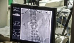 В Павлодаре провели уникальные операции по лечению варикоза малого таза