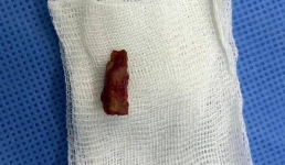 Павлодарские доктора вытащили инородное тело из виска мальчика