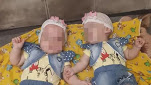 Родившиеся с минимальным весом близнецы из Павлодара нуждаются в лечении от гидроцефалии