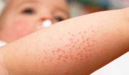 В Павлодарской области стали меньше болеть скарлатиной