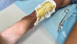 Кипяток и суп: как павлодарцам помочь детям при ожогах