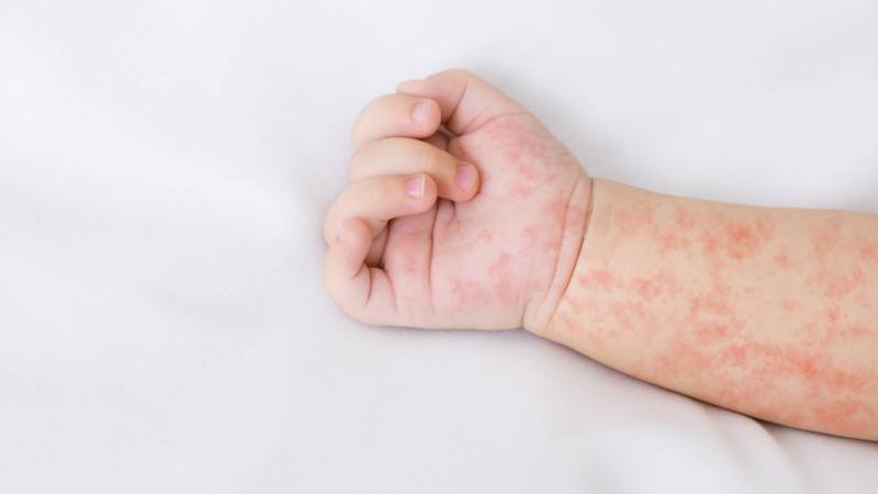 В Павлодаре летом дети стали чаще покрываться красными пятнами