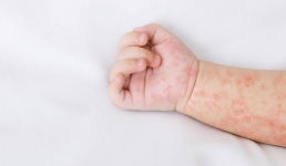 В Павлодаре летом дети стали чаще покрываться красными пятнами