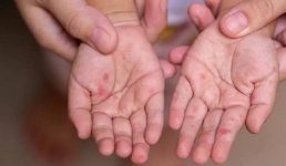 Более 208 миллионов тенге выделено на дополнительную массовую иммунизацию против кори в Мангистау